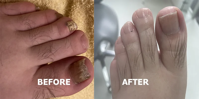 Fungal nails image 1