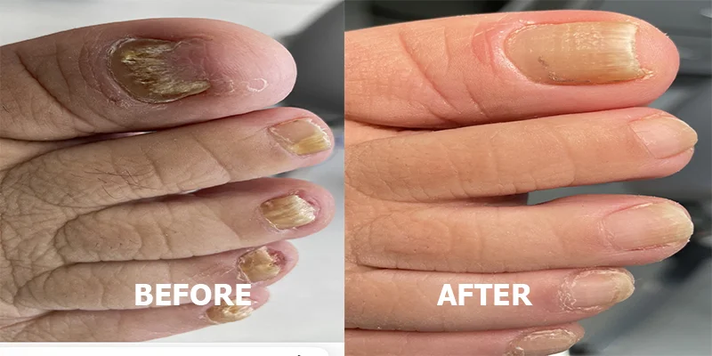 Fungal nails image 4