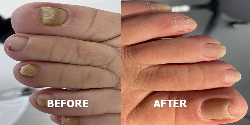 Fungal nails image 5